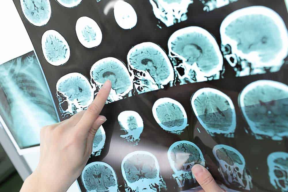 multiple sclerosis brain scan