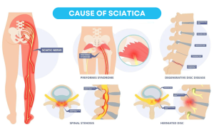 Cause of Sciatica