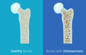 Healthy Bones vs Bones with Osteoporosis