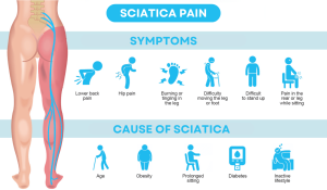 symptoms of Sciatica