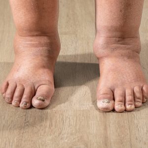 Lymphedema