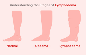 Stages of Lymphedema